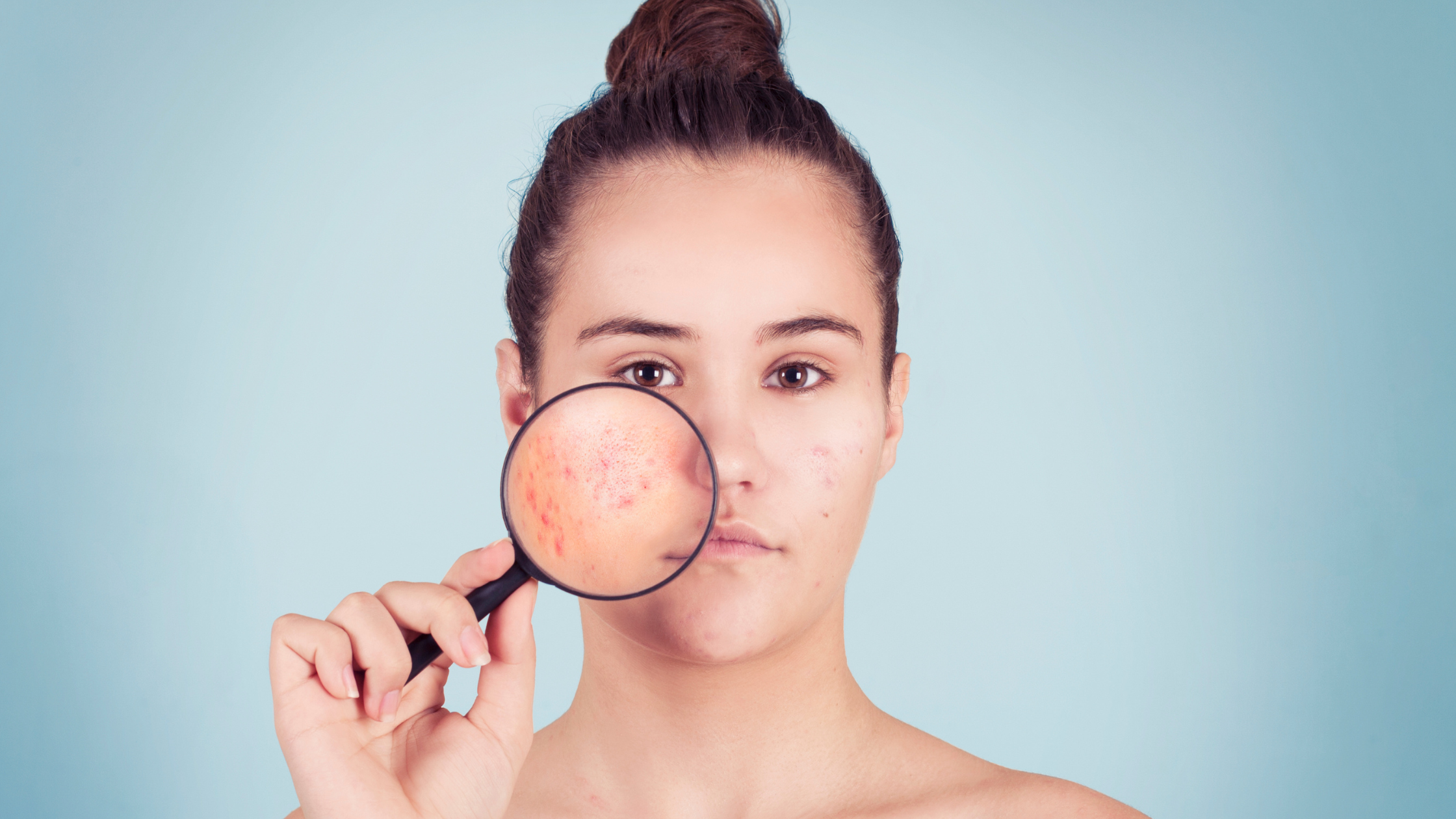 Blive skør Ørken Meget sur Red Light Therapy for Acne: Does It Really Work? | Renew With Heather
